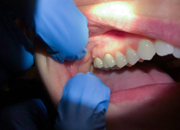 Best Dentist for Tooth Abscess  in Scott, LA