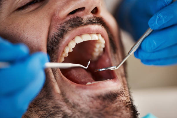Best Chipped Tooth Repair Near Me  in Scott, LA